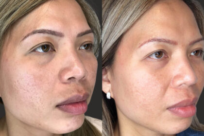 rf microneedling near me