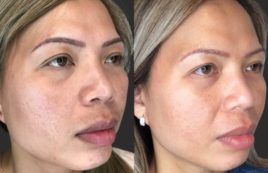 rf microneedling near me