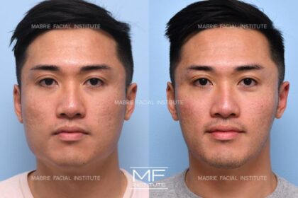 botox for face slimming