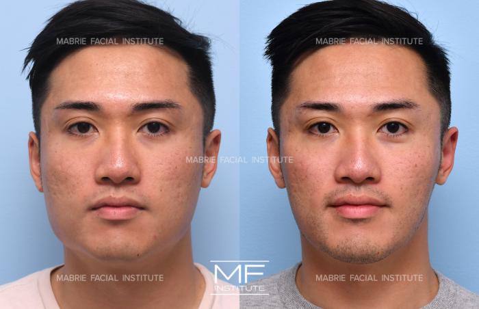 botox for face slimming